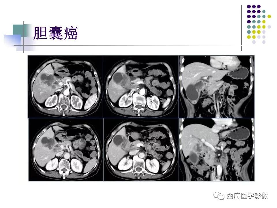 影像PPT - 【PPT】黄色肉芽肿性胆囊炎的影像诊断-29