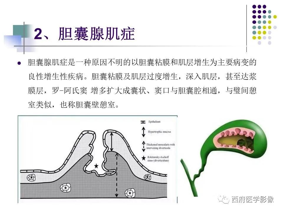 影像PPT - 【PPT】黄色肉芽肿性胆囊炎的影像诊断-30