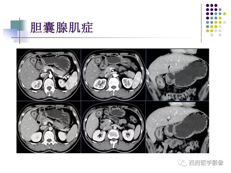 影像PPT - 【PPT】黄色肉芽肿性胆囊炎的影像诊断-32
