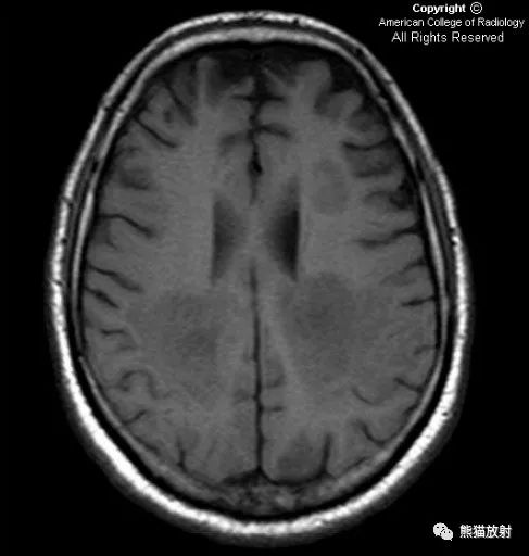 影像PPT - 【病例】同心圆性硬化1例MR影像-3 影像PPT - 【病例】同心圆性硬化1例MR影像-3