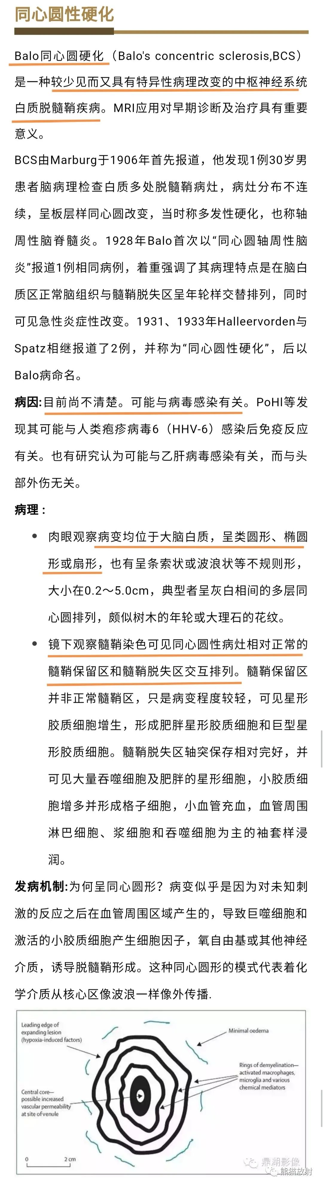 影像PPT - 【病例】同心圆性硬化1例MR影像-6 影像PPT - 【病例】同心圆性硬化1例MR影像-6