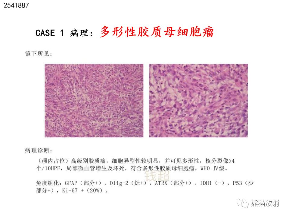 影像PPT - 【病例】多形性胶质母细胞瘤2例MR-17
