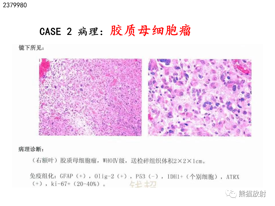影像PPT - 【病例】多形性胶质母细胞瘤2例MR-18