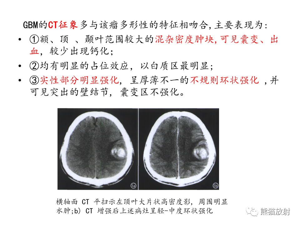 影像PPT - 【病例】多形性胶质母细胞瘤2例MR-21