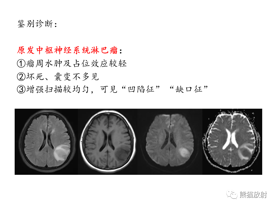 影像PPT - 【病例】多形性胶质母细胞瘤2例MR-23