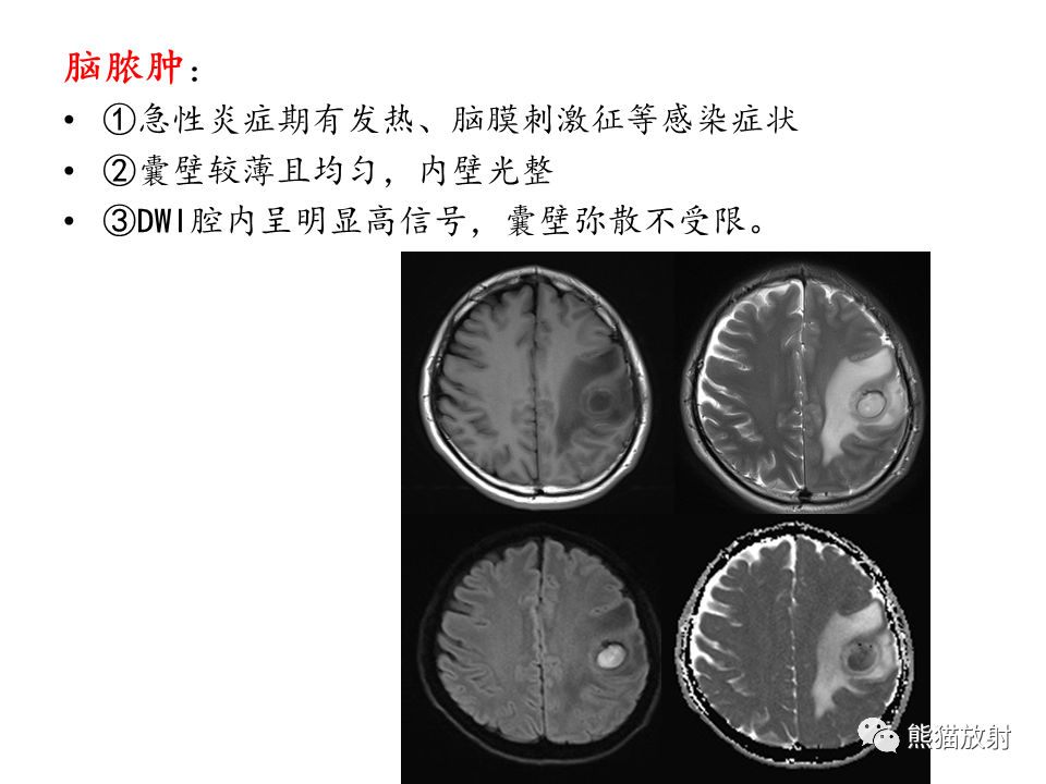 影像PPT - 【病例】多形性胶质母细胞瘤2例MR-24