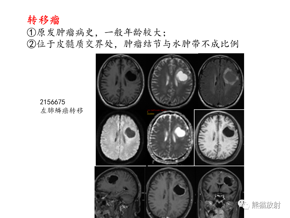 影像PPT - 【病例】多形性胶质母细胞瘤2例MR-25