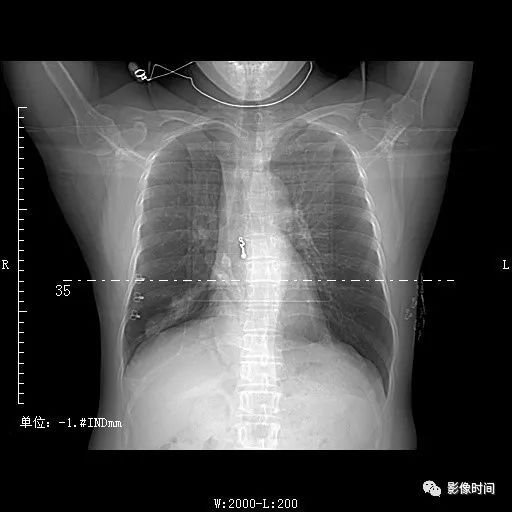 影像PPT - 真真假假的“支气管树爬行征”,身世可能更复杂-13 影像PPT - 真真假假的“支气管树爬行征”,身世可能更复杂-13
