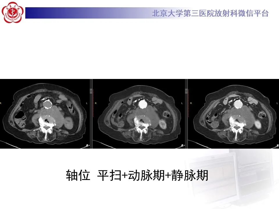 影像PPT - 【病例】慢性包裹性腹主动脉瘤破裂1例CT影像-3