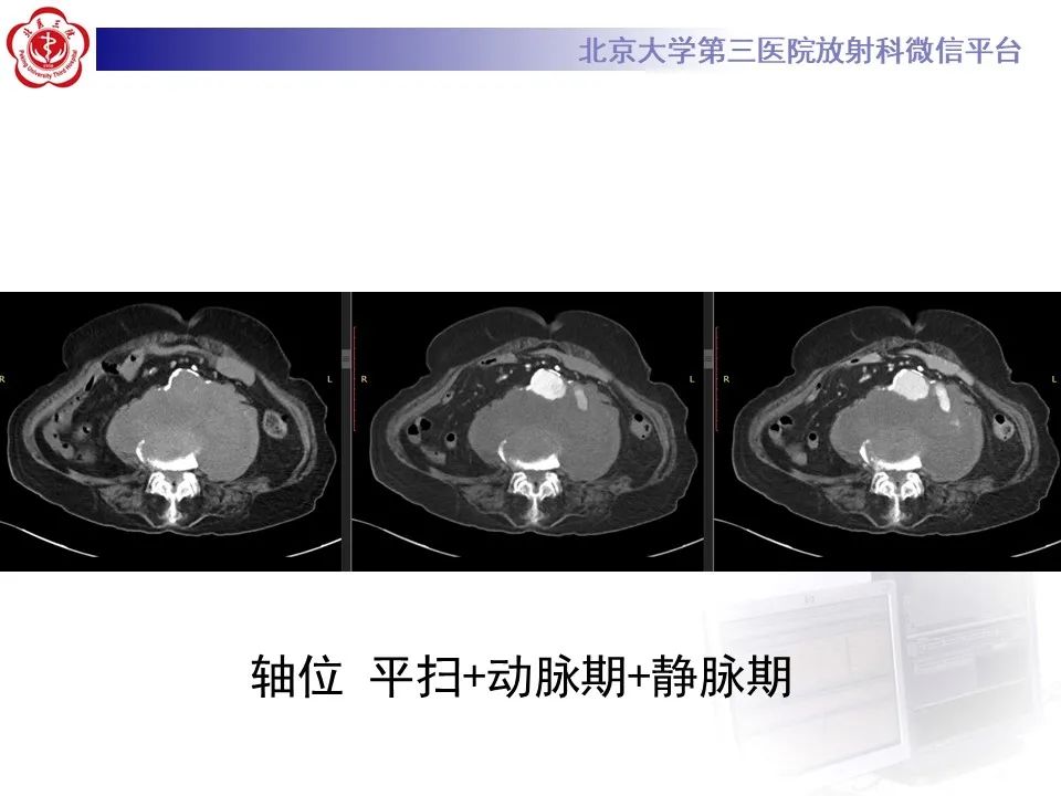 影像PPT - 【病例】慢性包裹性腹主动脉瘤破裂1例CT影像-4