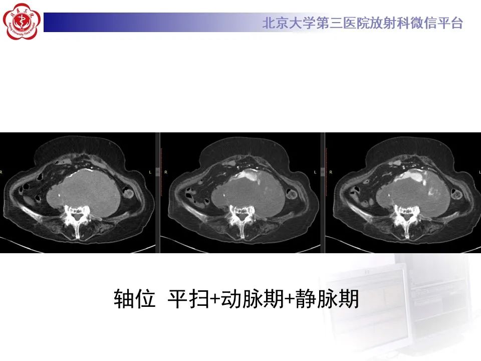 影像PPT - 【病例】慢性包裹性腹主动脉瘤破裂1例CT影像-5