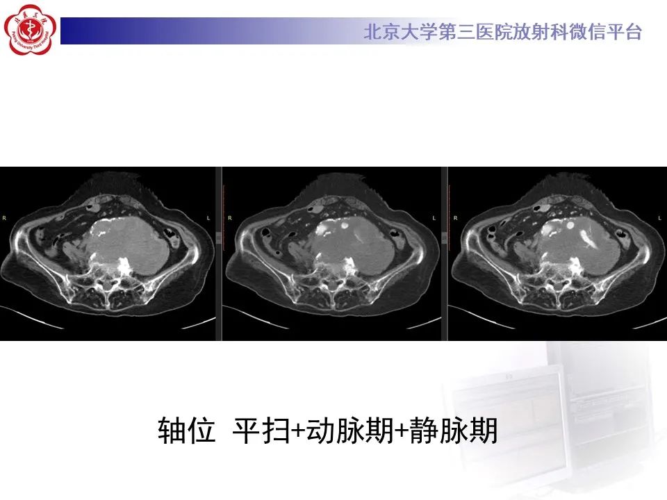 影像PPT - 【病例】慢性包裹性腹主动脉瘤破裂1例CT影像-6