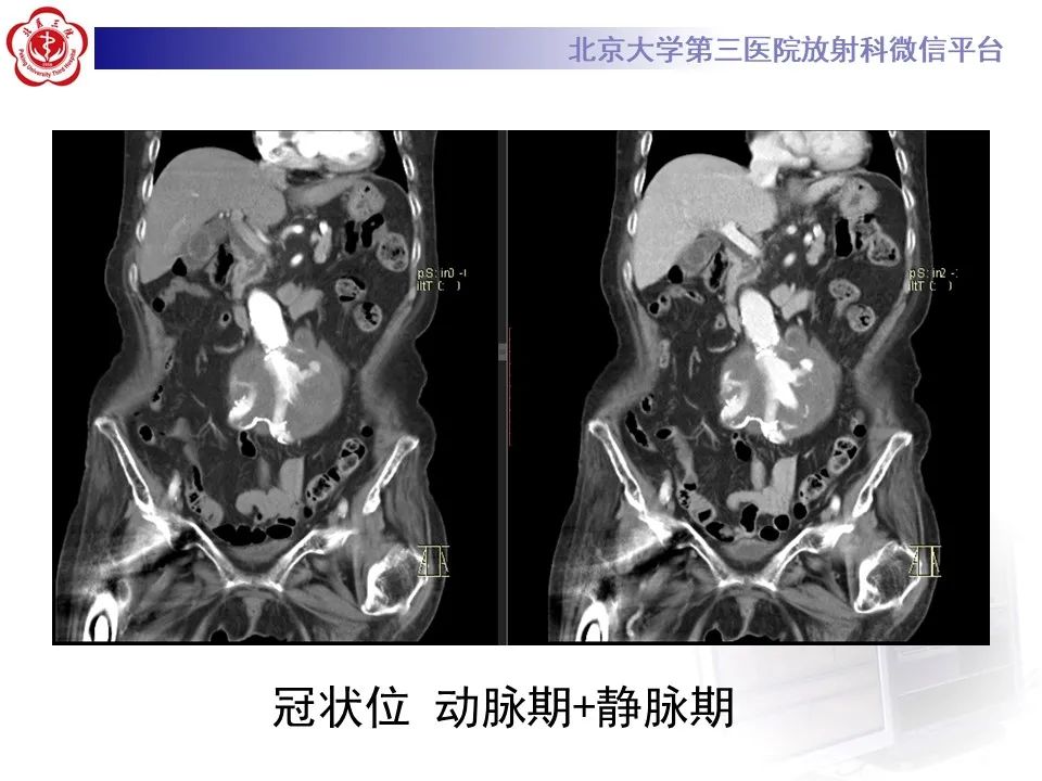 影像PPT - 【病例】慢性包裹性腹主动脉瘤破裂1例CT影像-7