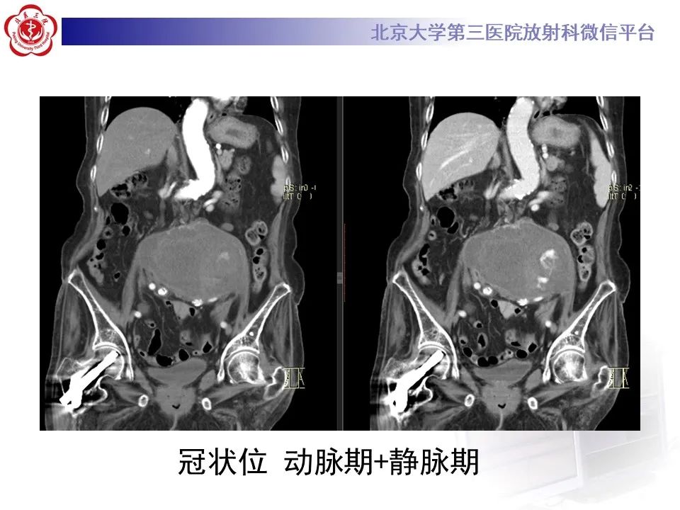影像PPT - 【病例】慢性包裹性腹主动脉瘤破裂1例CT影像-8