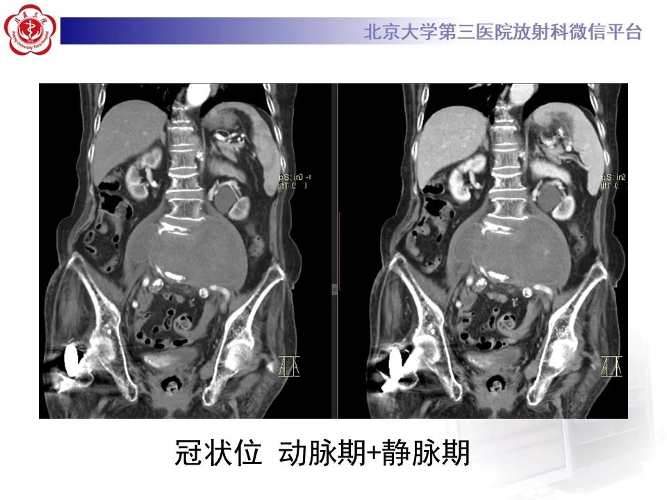 影像PPT - 【病例】慢性包裹性腹主动脉瘤破裂1例CT影像-9