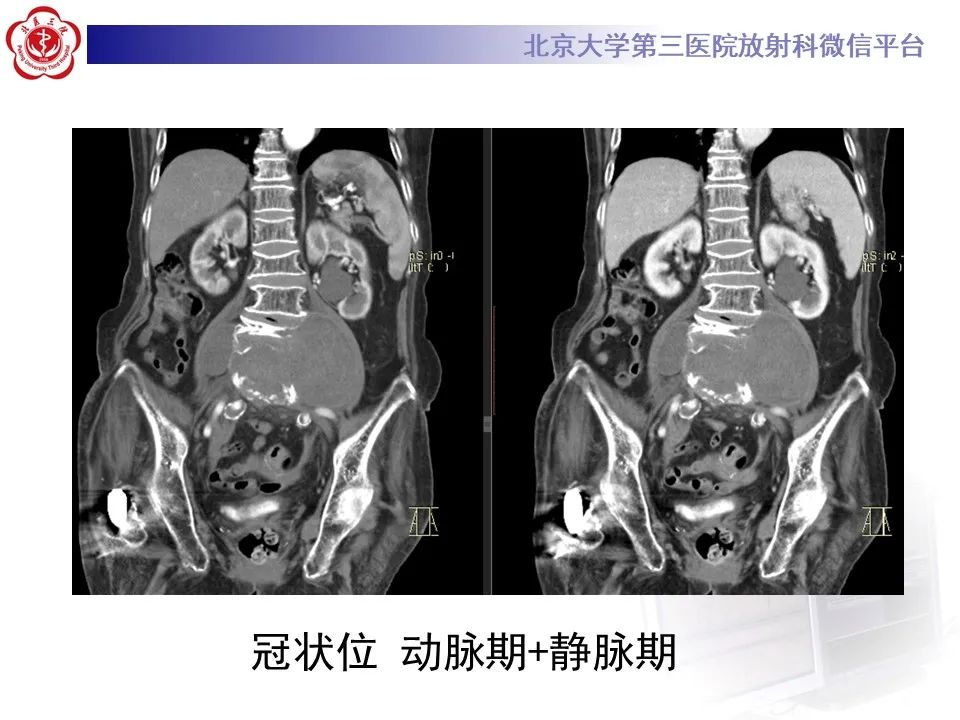 影像PPT - 【病例】慢性包裹性腹主动脉瘤破裂1例CT影像-10