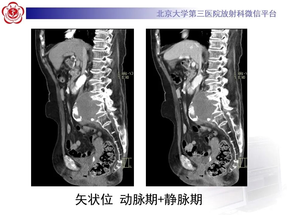 影像PPT - 【病例】慢性包裹性腹主动脉瘤破裂1例CT影像-11