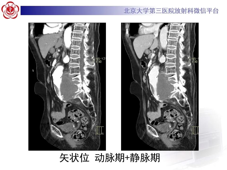影像PPT - 【病例】慢性包裹性腹主动脉瘤破裂1例CT影像-12