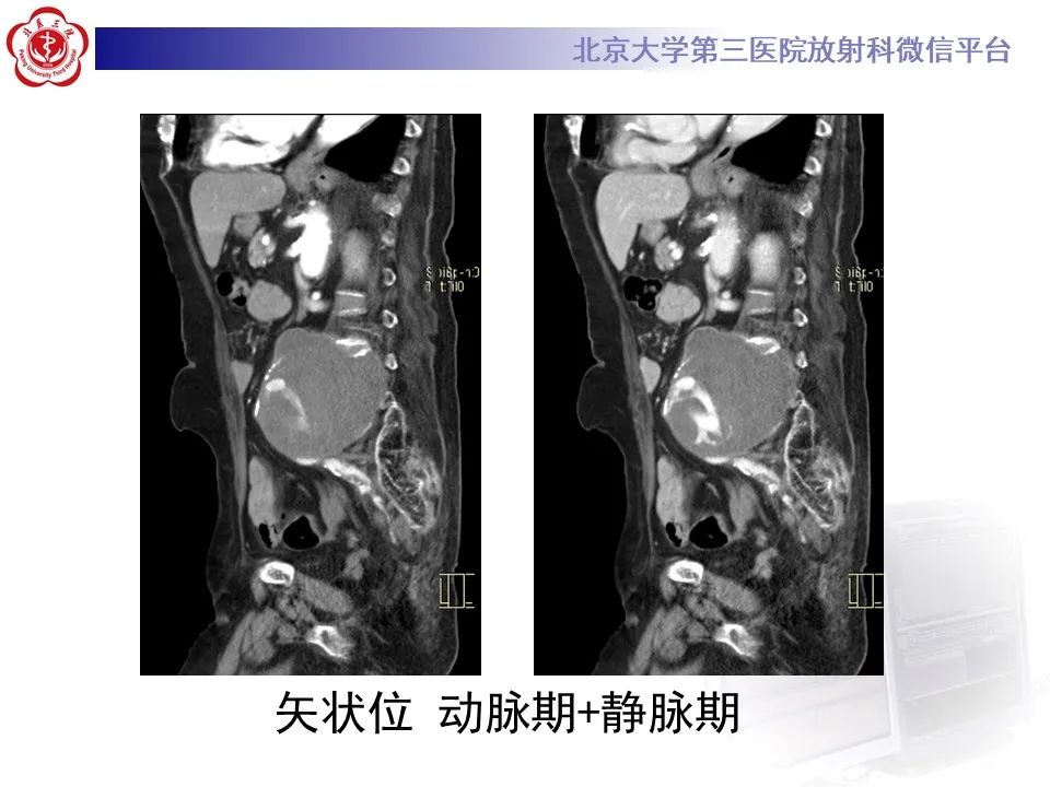 影像PPT - 【病例】慢性包裹性腹主动脉瘤破裂1例CT影像-13