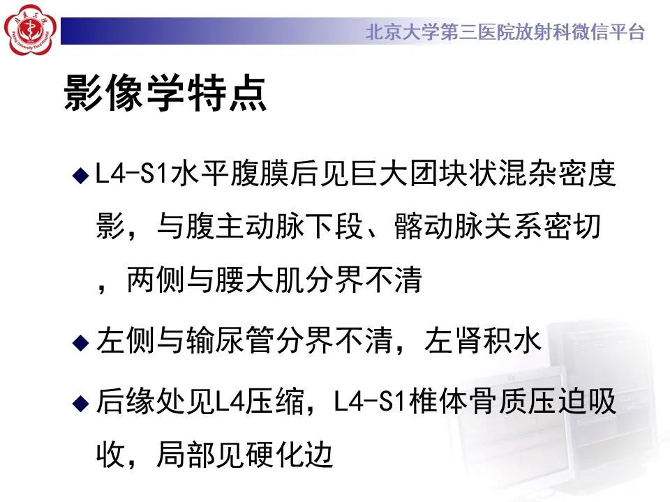 影像PPT - 【病例】慢性包裹性腹主动脉瘤破裂1例CT影像-14