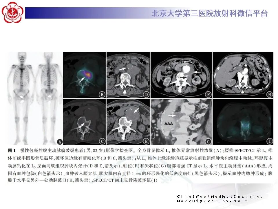 影像PPT - 【病例】慢性包裹性腹主动脉瘤破裂1例CT影像-28
