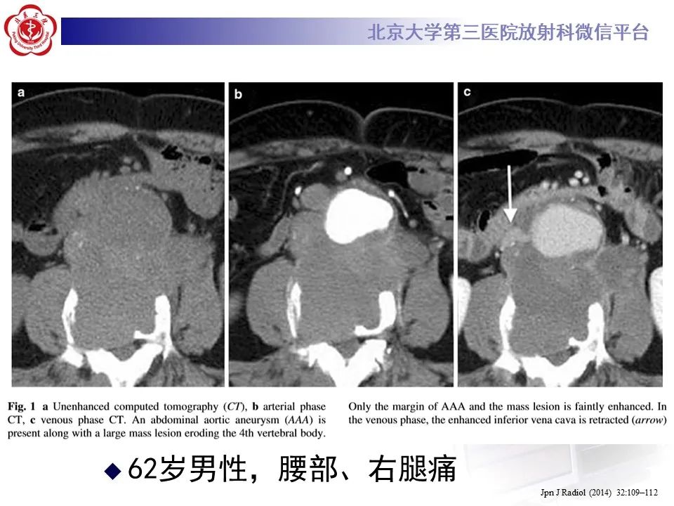 影像PPT - 【病例】慢性包裹性腹主动脉瘤破裂1例CT影像-29