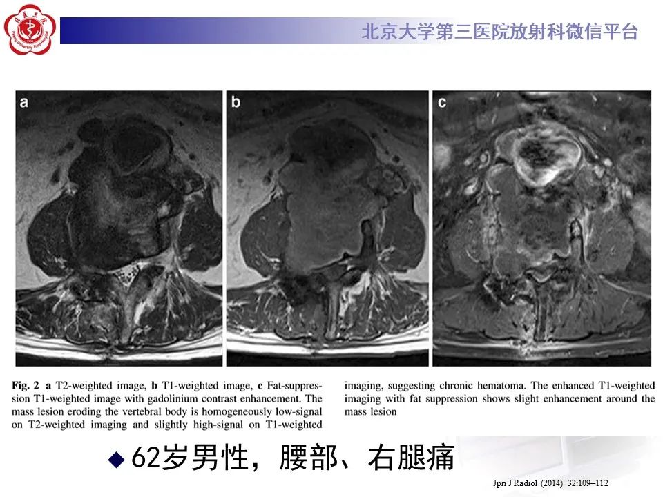 影像PPT - 【病例】慢性包裹性腹主动脉瘤破裂1例CT影像-30