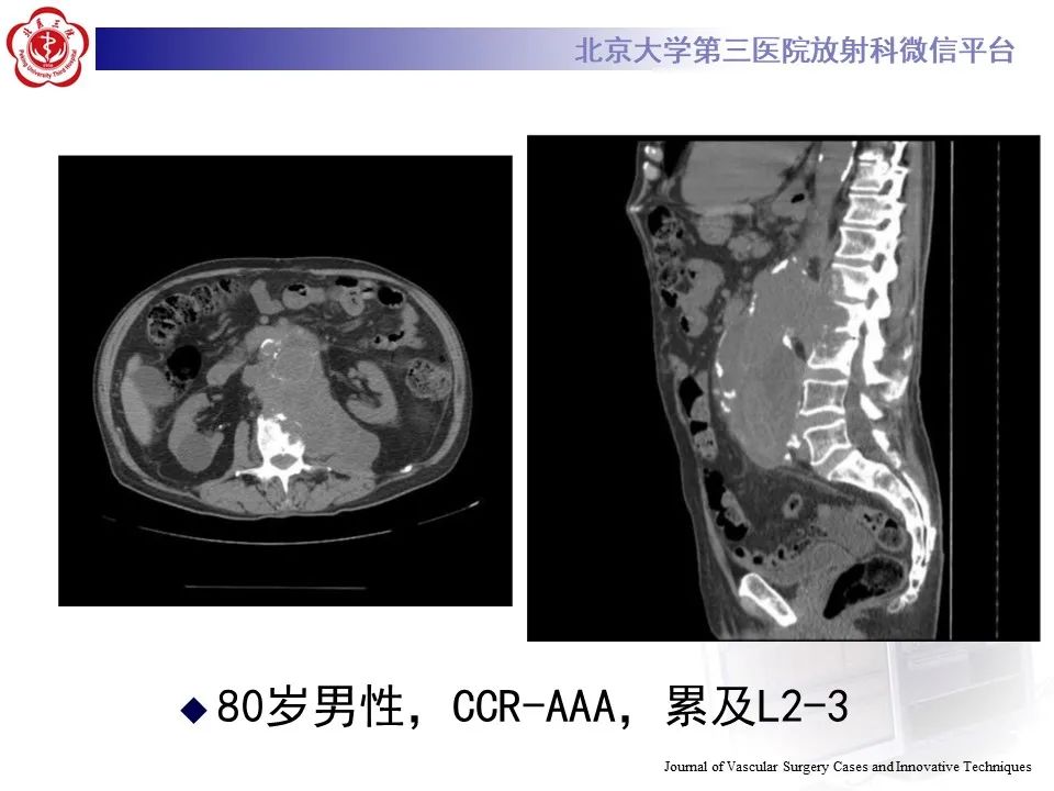 影像PPT - 【病例】慢性包裹性腹主动脉瘤破裂1例CT影像-31