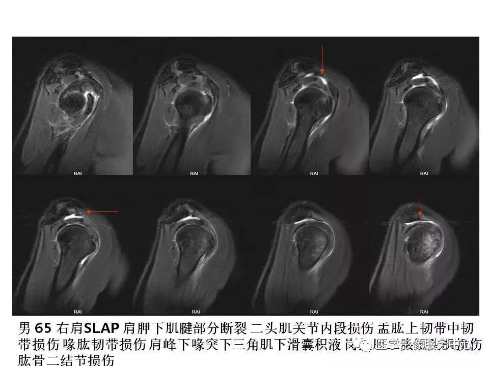 影像PPT - 【PPT】肩关节韧带及损伤的MR表现-15