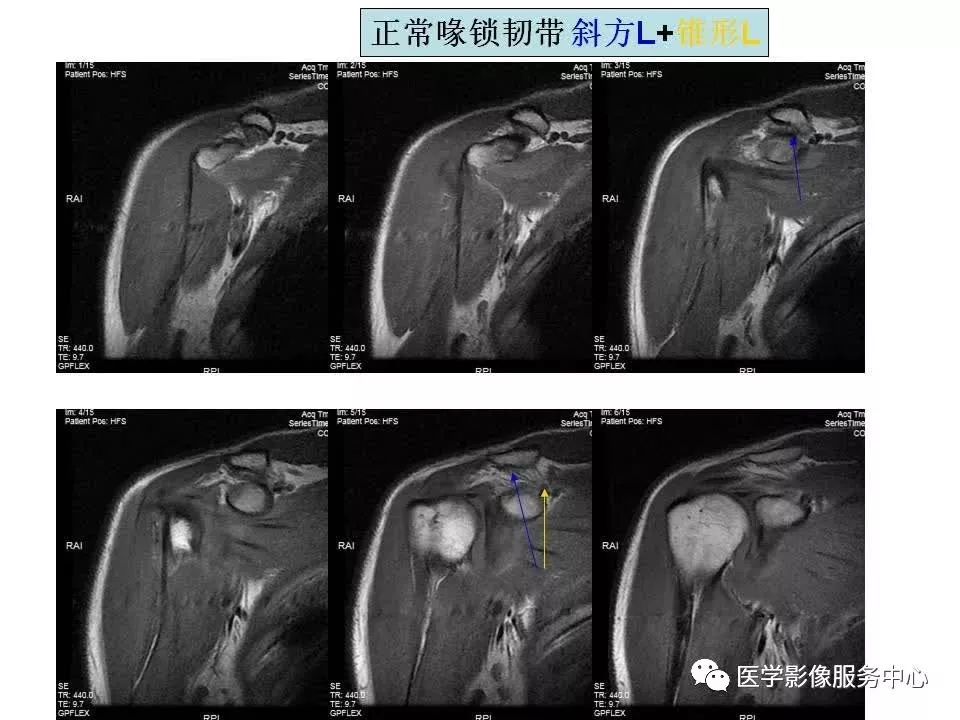 影像PPT - 【PPT】肩关节韧带及损伤的MR表现-19