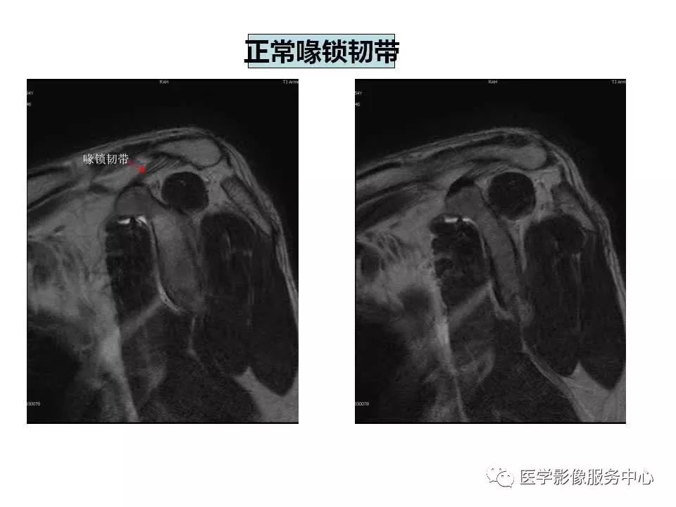 影像PPT - 【PPT】肩关节韧带及损伤的MR表现-20