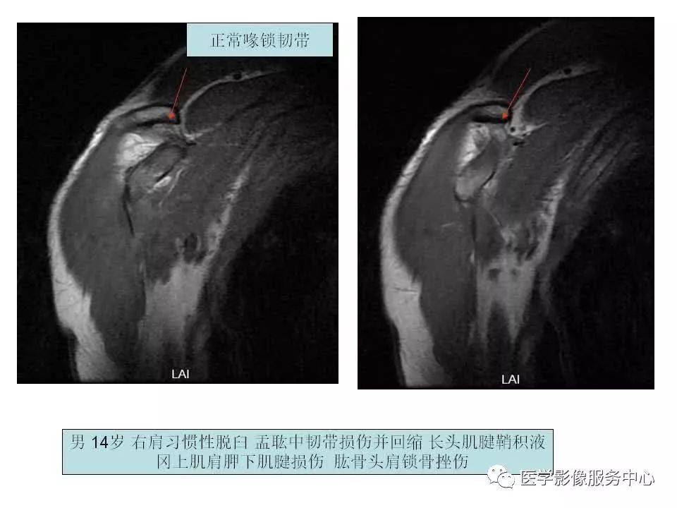 影像PPT - 【PPT】肩关节韧带及损伤的MR表现-22