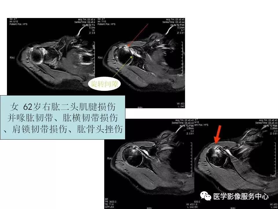 影像PPT - 【PPT】肩关节韧带及损伤的MR表现-29
