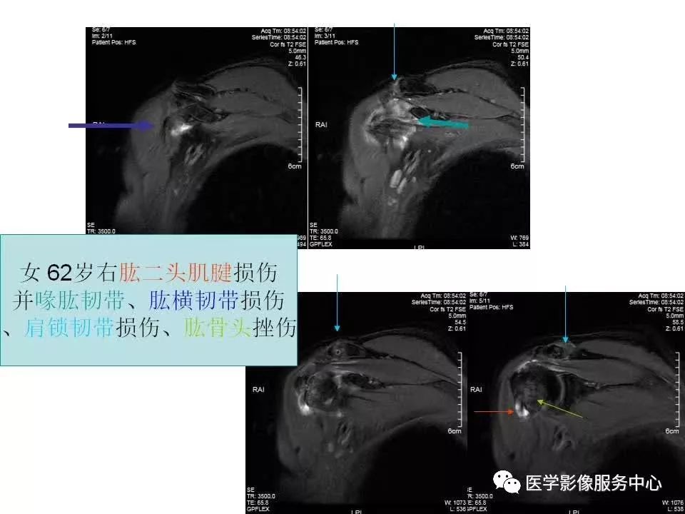 影像PPT - 【PPT】肩关节韧带及损伤的MR表现-30