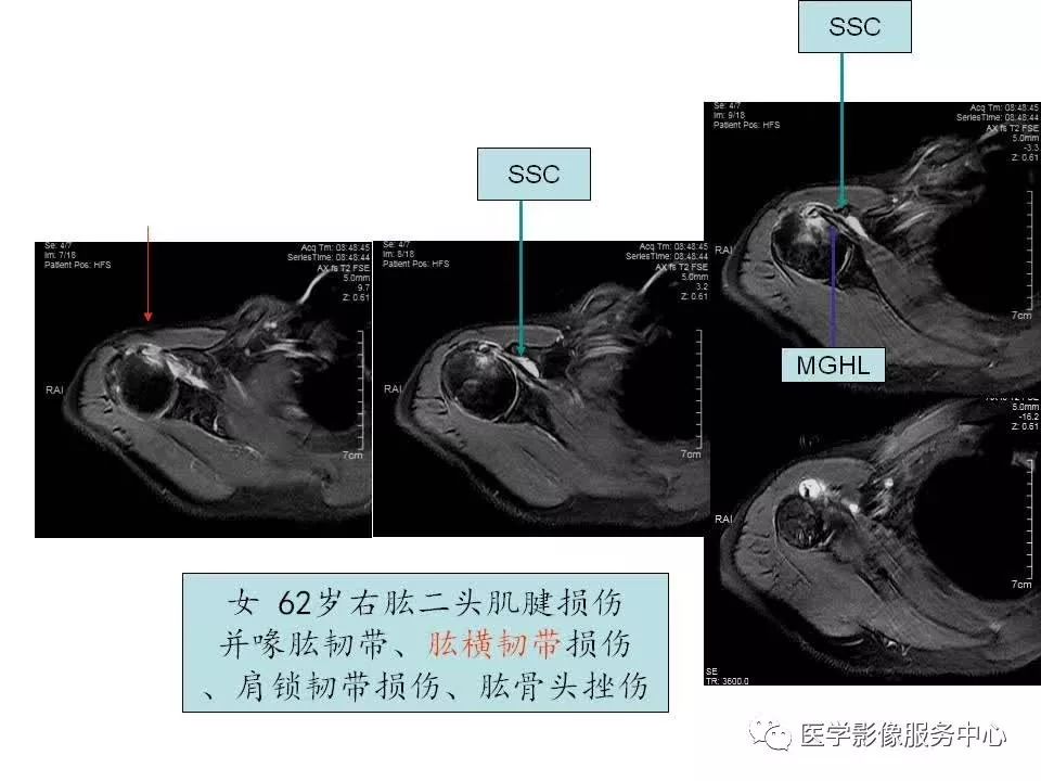 影像PPT - 【PPT】肩关节韧带及损伤的MR表现-35