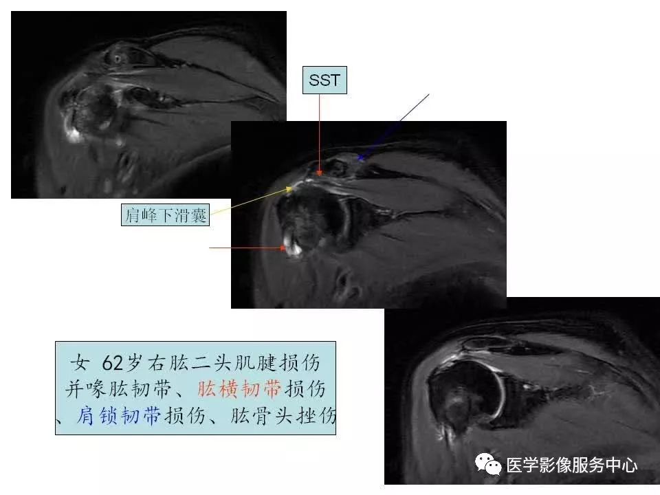 影像PPT - 【PPT】肩关节韧带及损伤的MR表现-36