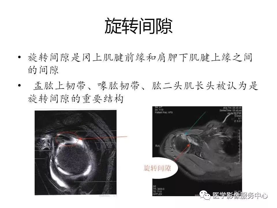 影像PPT - 【PPT】肩关节韧带及损伤的MR表现-49