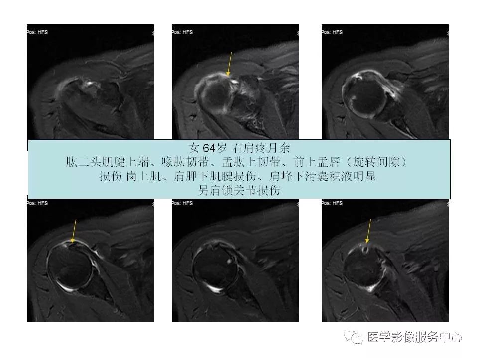影像PPT - 【PPT】肩关节韧带及损伤的MR表现-56
