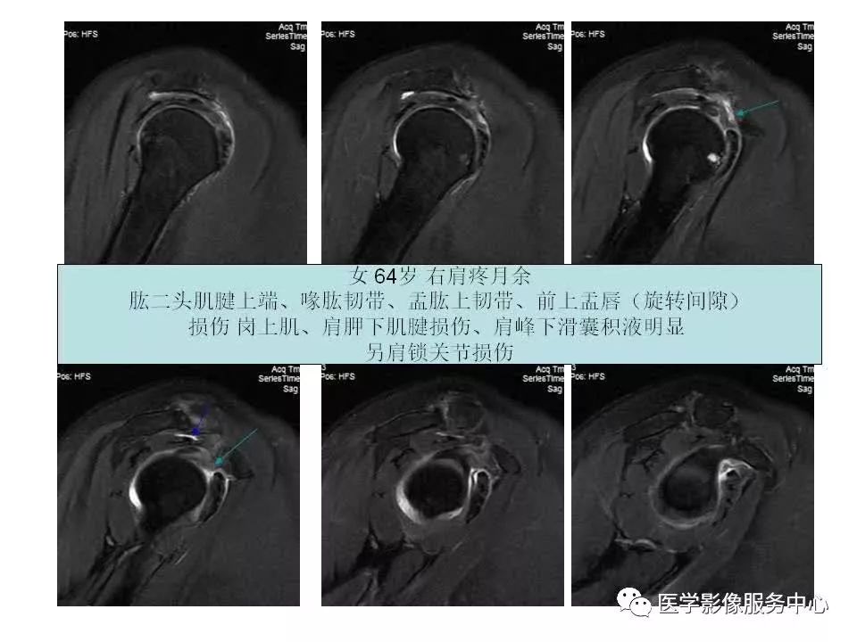 影像PPT - 【PPT】肩关节韧带及损伤的MR表现-58