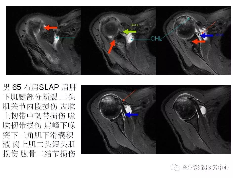 影像PPT - 【PPT】肩关节韧带及损伤的MR表现-64