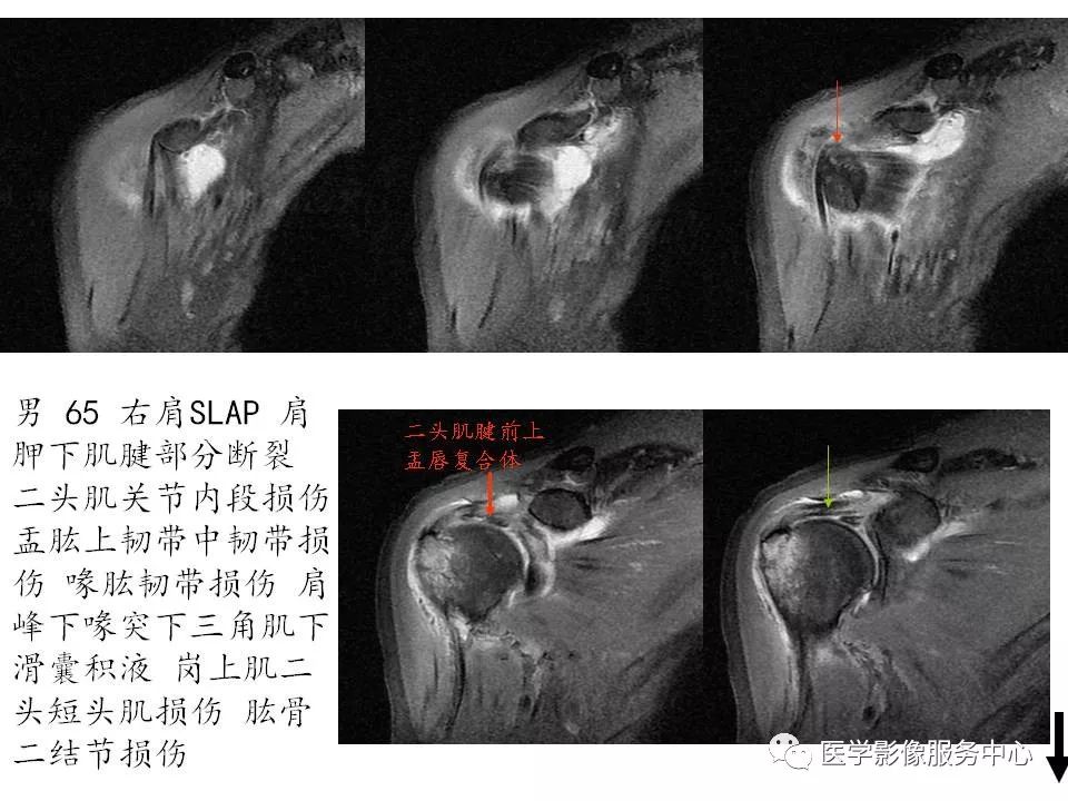 影像PPT - 【PPT】肩关节韧带及损伤的MR表现-66