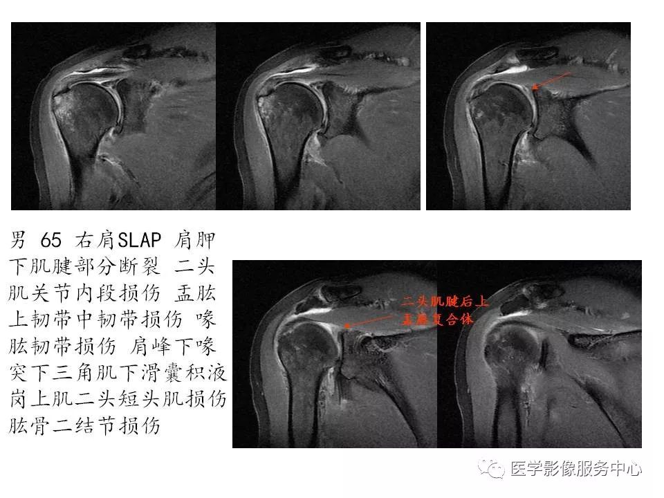 影像PPT - 【PPT】肩关节韧带及损伤的MR表现-67