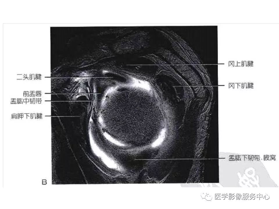 影像PPT - 【PPT】肩关节韧带及损伤的MR表现-69