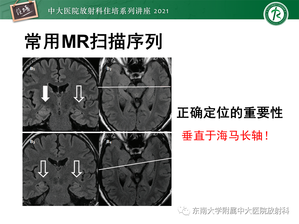 影像PPT - 【PPT】癫痫MR成像与常见疾病-10