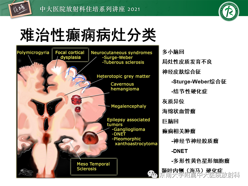 影像PPT - 【PPT】癫痫MR成像与常见疾病-11