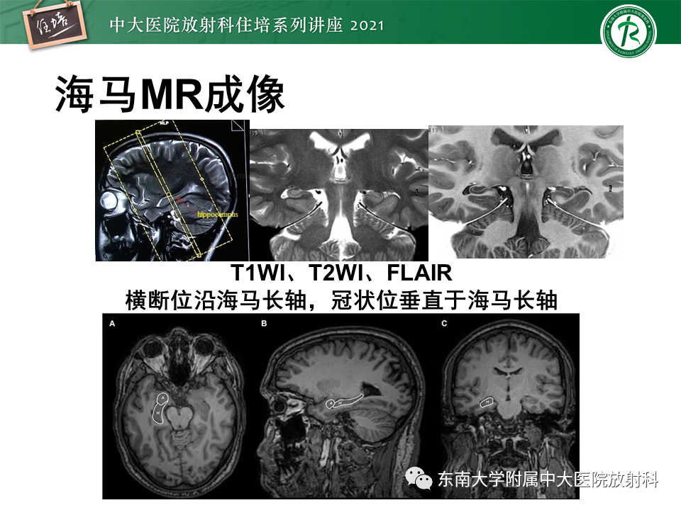 影像PPT - 【PPT】癫痫MR成像与常见疾病-16