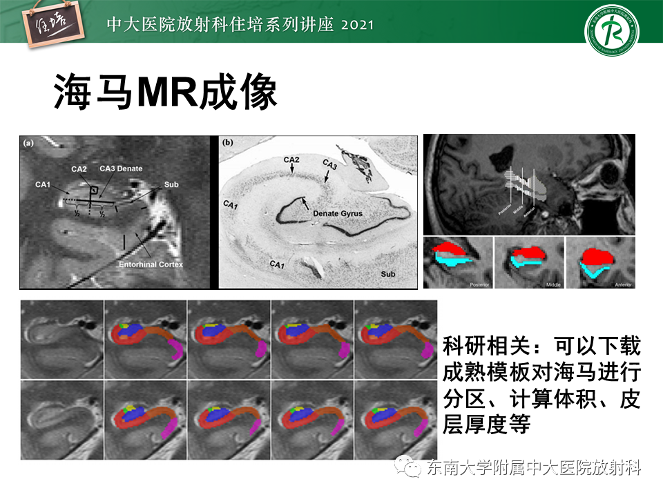 影像PPT - 【PPT】癫痫MR成像与常见疾病-17