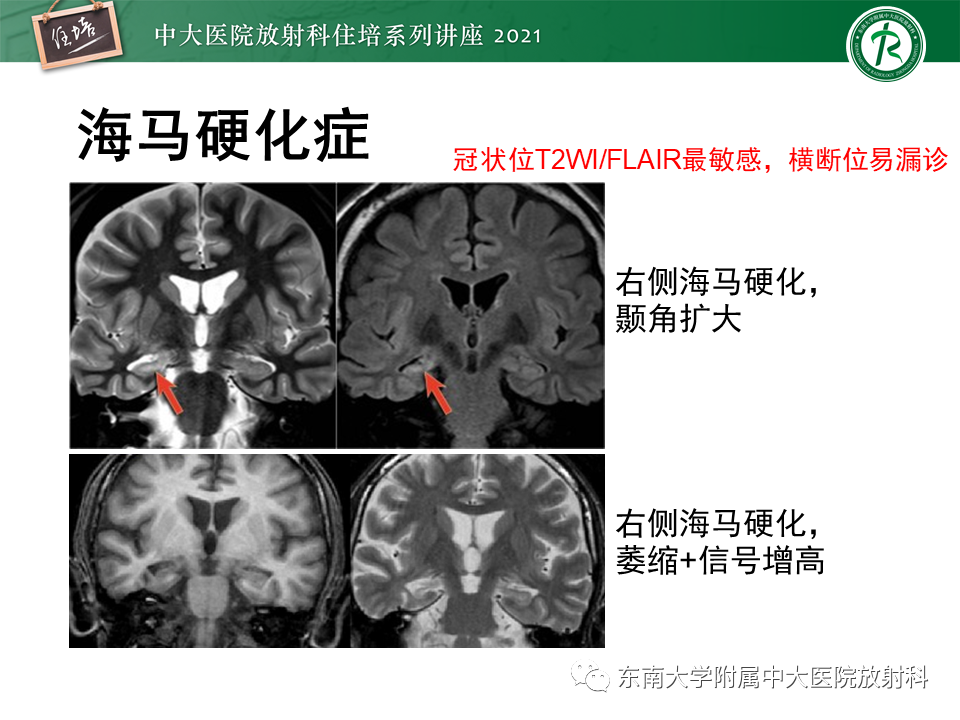 影像PPT - 【PPT】癫痫MR成像与常见疾病-20