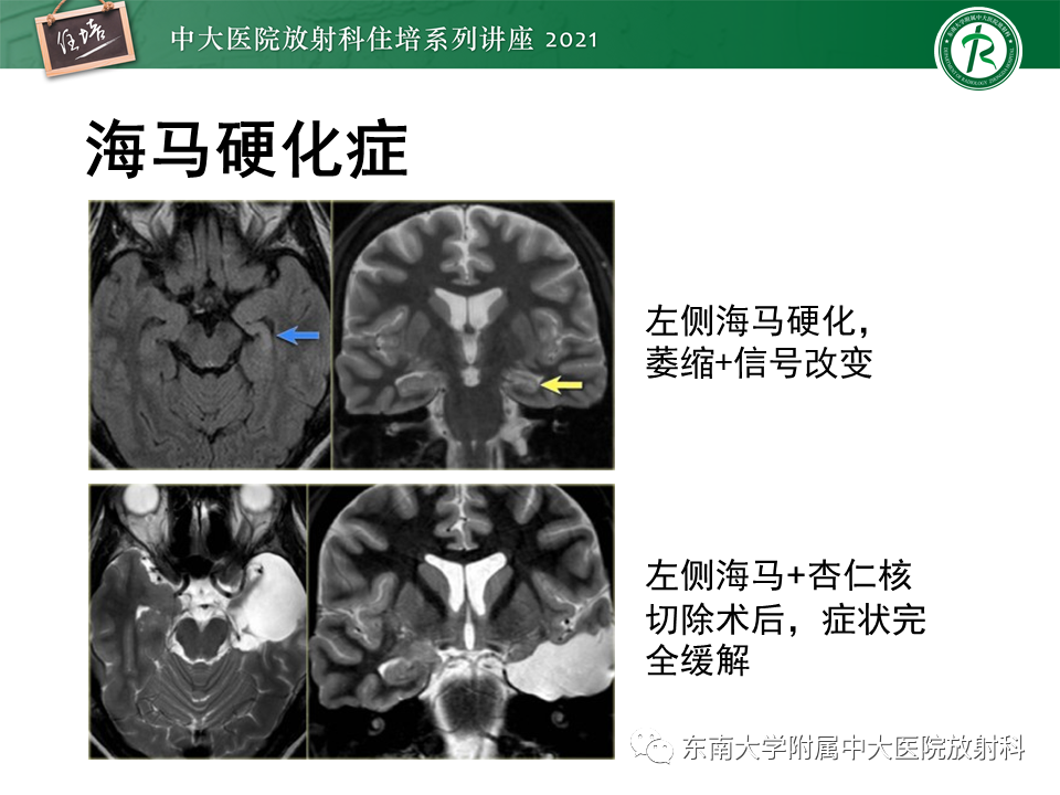 影像PPT - 【PPT】癫痫MR成像与常见疾病-21