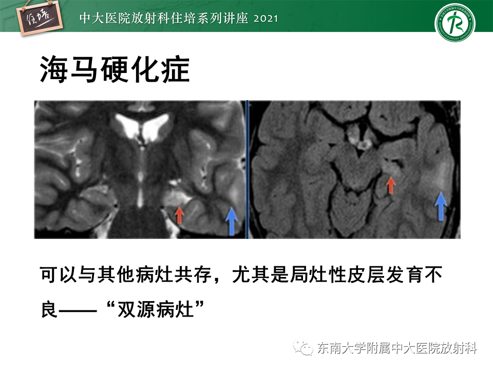 影像PPT - 【PPT】癫痫MR成像与常见疾病-22